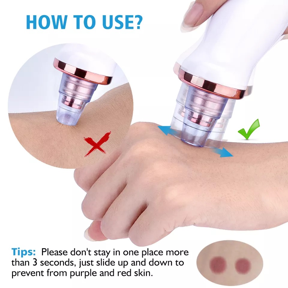 BLACKHEAD-REMOVER-5 مزيل الرؤوس السوداء